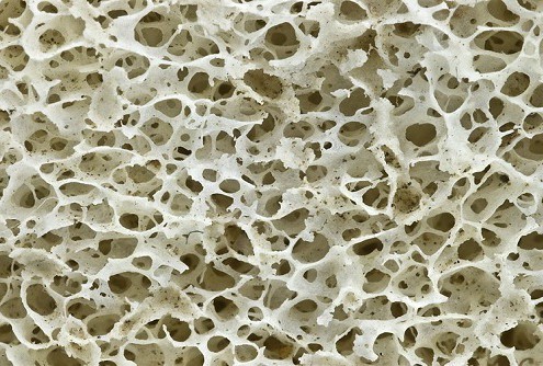 Osteoporosis - Seguro de Salud - Afemefa