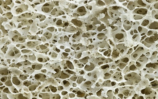 Osteoporosis - Seguro de Salud - Afemefa